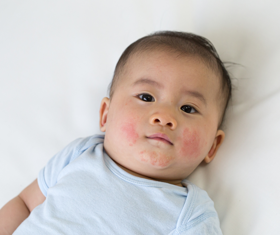 Do babies grow out of eczema